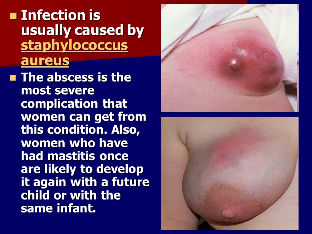 Infection is usually caused by staphylococcus aureus The abscess is the most severe complication